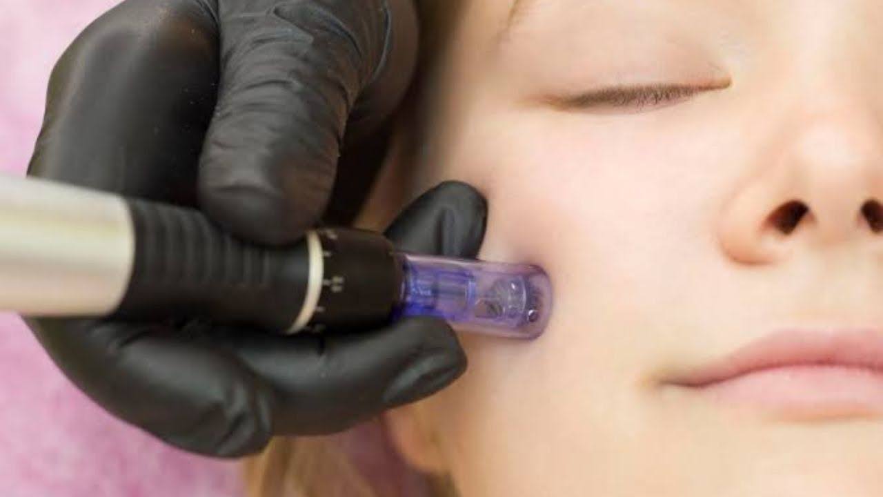 RF Microneedling Boynton Beach | Skin Guide